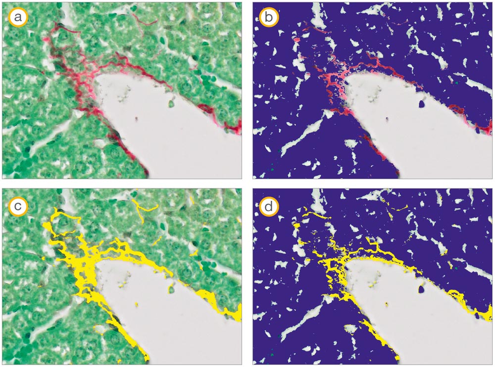 Mouse liver tissue: (a) source image, (b) manual threshold setting (blue) for the green stained tissue, (c) manual threshold setting (yellow) for the red stained fibers and (d) combined threshold of the two phases