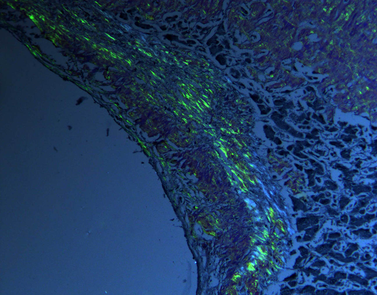 Menschliches Gewebe mit Amyloidose unter dem Mikroskop