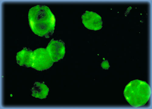 HIV Infected Lympocytes